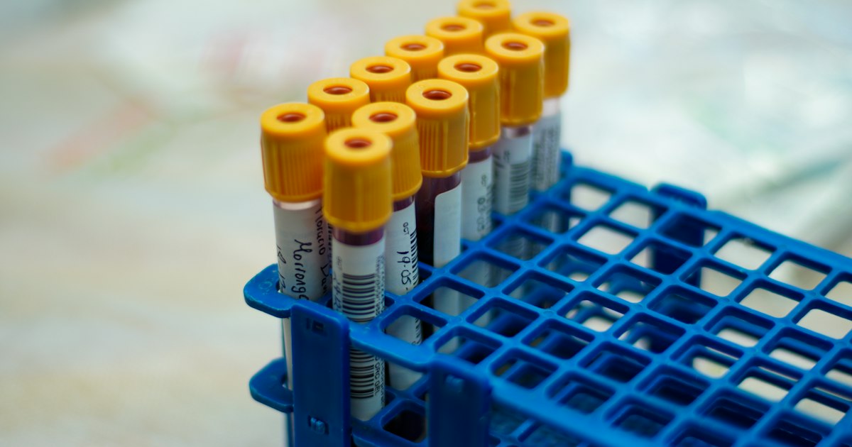 Hoe u zich voorbereidt op de test 'Homocysteïne': regels voor de afname